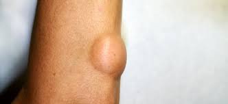 lipoma-kumaran